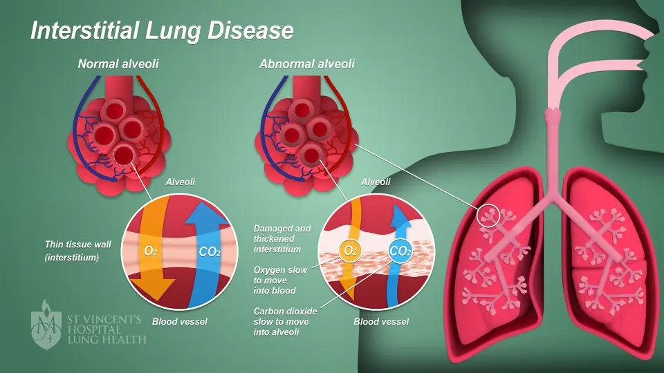 2 SVH Lung Health Interstitial Lung Disease final 1080